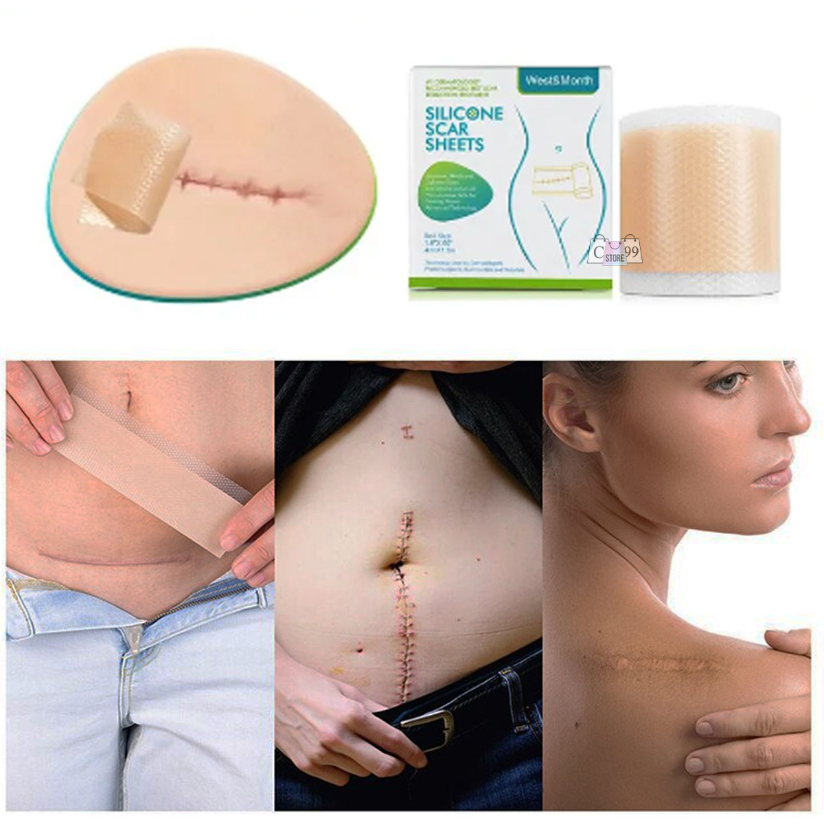 Miniatura 2 de Cinta Silicona Para Eliminar Cicatrices